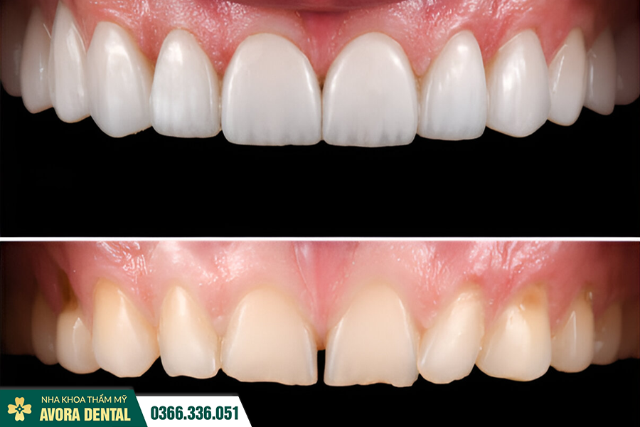 Nha khoa Bác sĩ Trung Hiếu – Địa chỉ Dán Răng Sứ Trả Góp Lãi Suất 0%