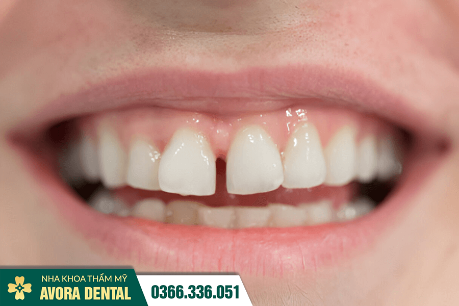 Dán Sứ Veneer Răng Cửa Là Gì? Có Tốt Không? Giá Bao Nhiêu 2025?