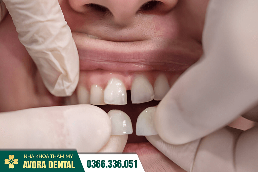 Dán Răng Sứ Thẩm Mỹ Veneer Là Gì? Chi Phí Bao Nhiêu 2025