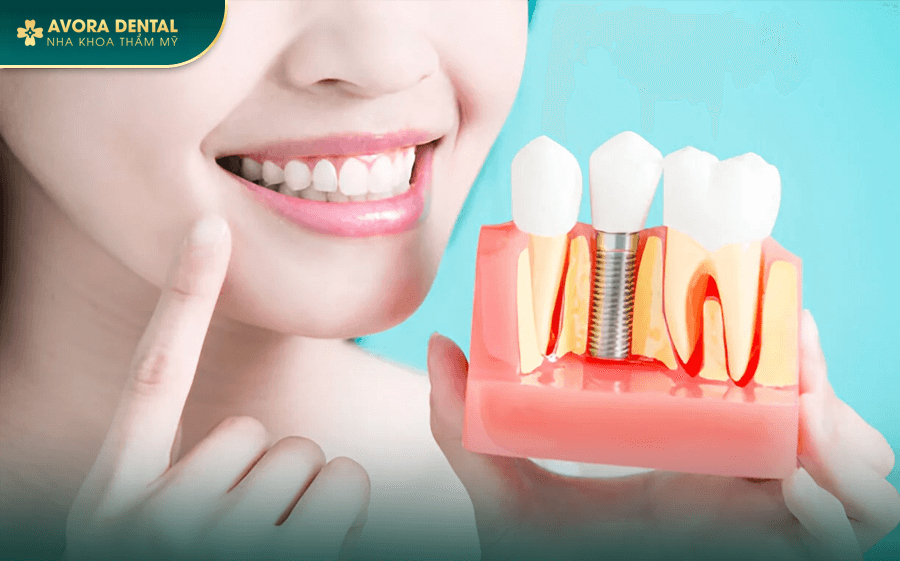 Trồng Răng Implant Trả Góp 0% Lãi Suất Tại Nha khoa Bác sĩ Trung Hiếu
