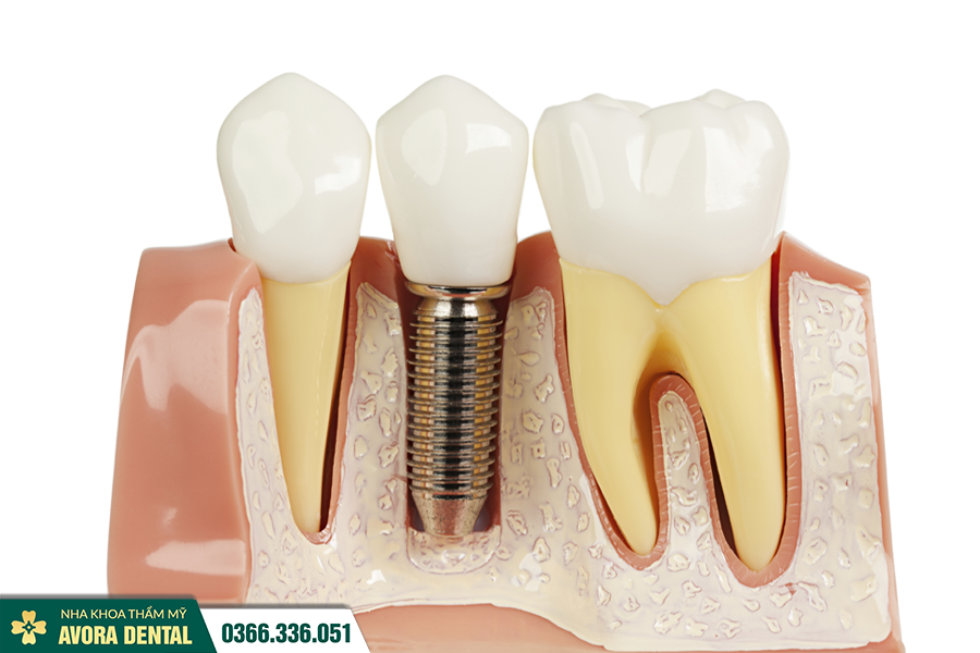 Bao Nhiêu Tuổi Thì Cấy Ghép Implant Được? Độ Tuổi Trồng Răng An toàn