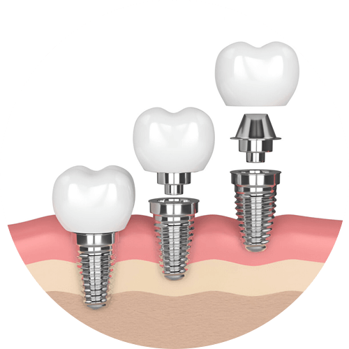 Trồng răng Implant