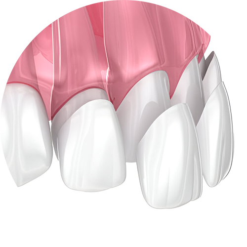 Dán sứ Veneer